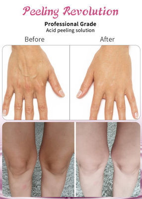 高品質 の 皮 peeling 血清 は,コラーゲン の 再生 を 促進 し,皮膚 を 向上 さ せる