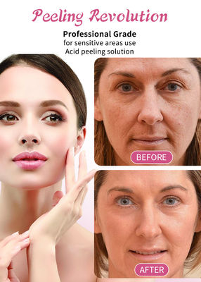 皮を剥がす血清 15% 剥離溶液 プロフェッショナルグレードの皮を剥がす血清