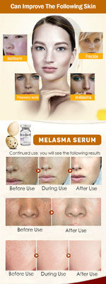 SkincareのMeso血清のMicroneedlingの取り外しのそばかすの血清Melasmaは白くの皮を剥ぐ