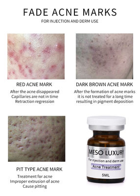 贅沢な青年血清の注入のMesotherapyの赤い点はアクネの注入の処置の皮を剥ぐ