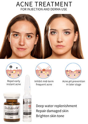 副作用を養わないStalidearmのアクネの処置の注入の血清Mesotherapy